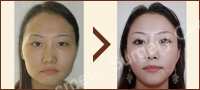 Before and After